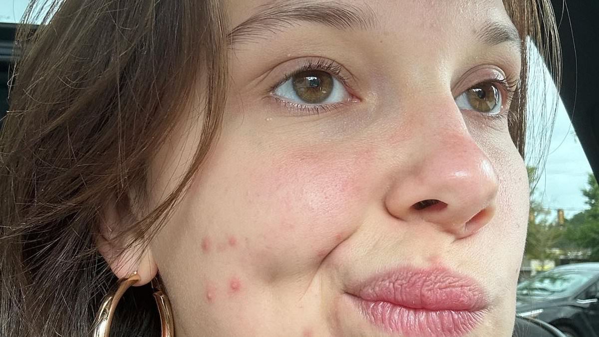alert-–-stranger-things-star-millie-bobby-brown-reveals-her-blemishes-in-a-candid-makeup-free-selfie-as-she-opens-up-on-her-acne-battle