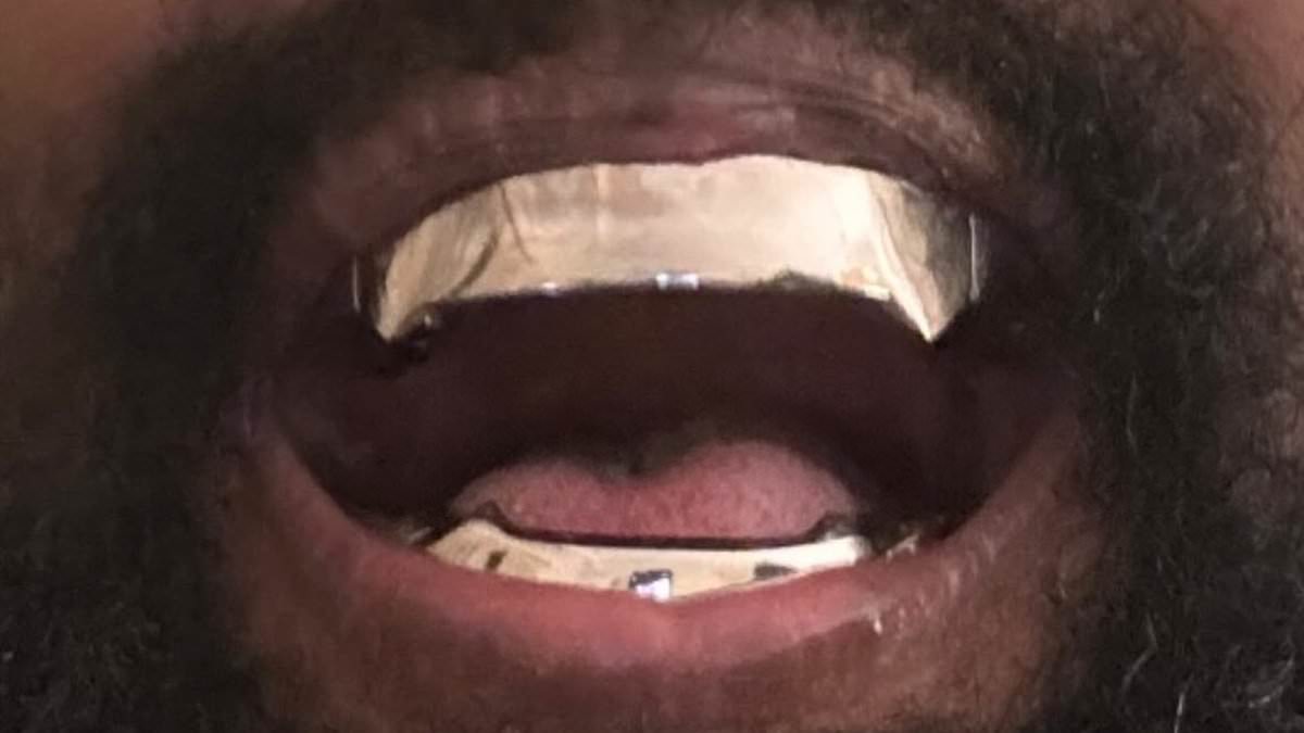 alert-–-kanye-west’s-$850k-titanium-dentures-are-compared-to-a-gum-wrapper-by-fans-who-brand-his-james-bond-villain-teeth-a-‘terrible-decision’:-‘what-happens-when-he-bites-his-tongue?’