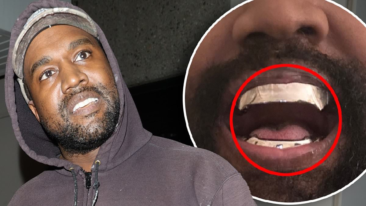 alert-–-top-dentist-reveals-the-huge-problem-with-kanye-west’s-new-titanium-teeth-–-and-exposes-the-real-cost-of-his-‘850k’-jaws