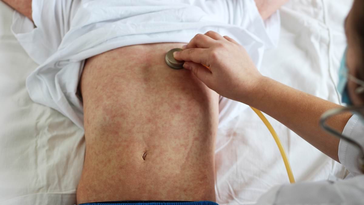 alert-–-sydney-measles:-infant-sparks-health-fears-after-testing-positive-for-highly-contagious-disease