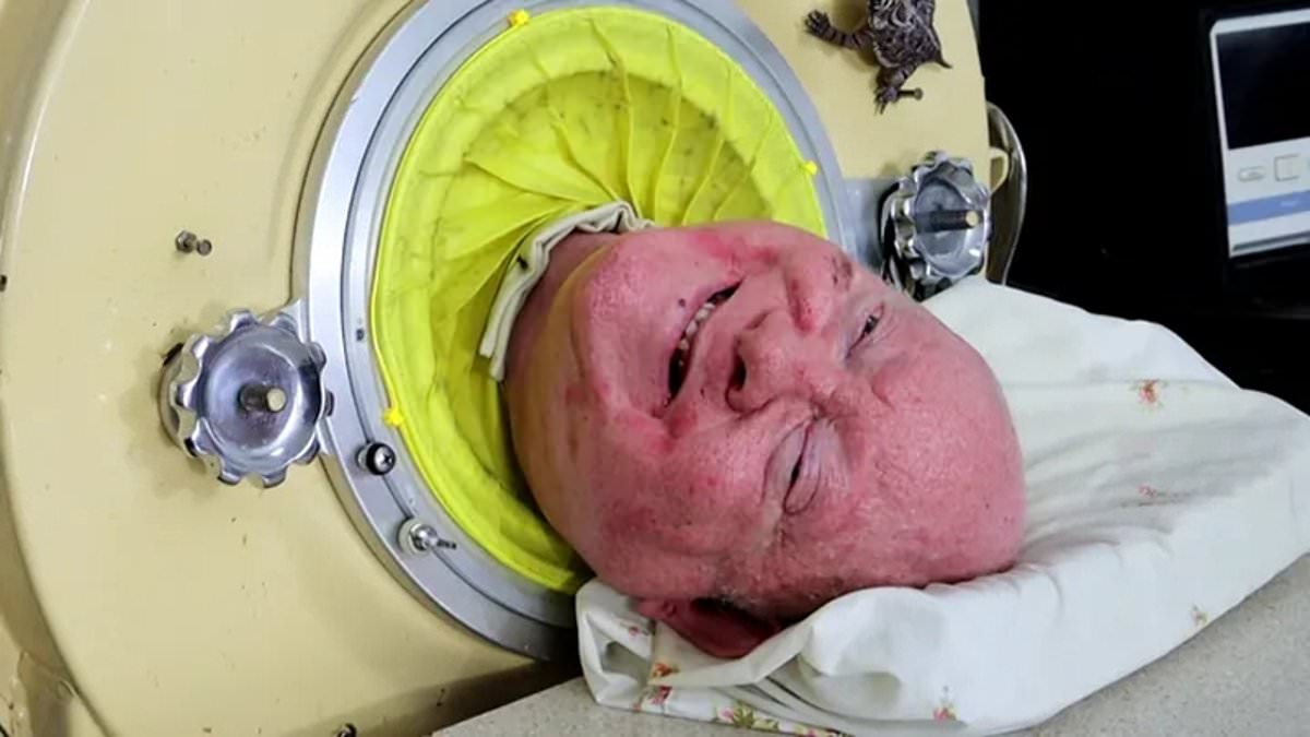 alert-–-iron-lung-man-paul-alexander-dead-at-78:-lawyer-who-was-paralysed-after-suffering-polio-as-a-six-year-old-and-lived-in-an-iron-lung-for-70-years-dies