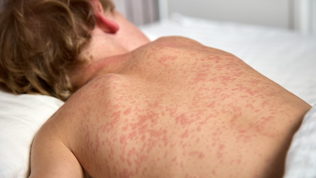 alert-–-health-alert-issued-after-measles-case-detected-in-sydney:-these-are-the-symptoms-you-need-to-watch-out-for