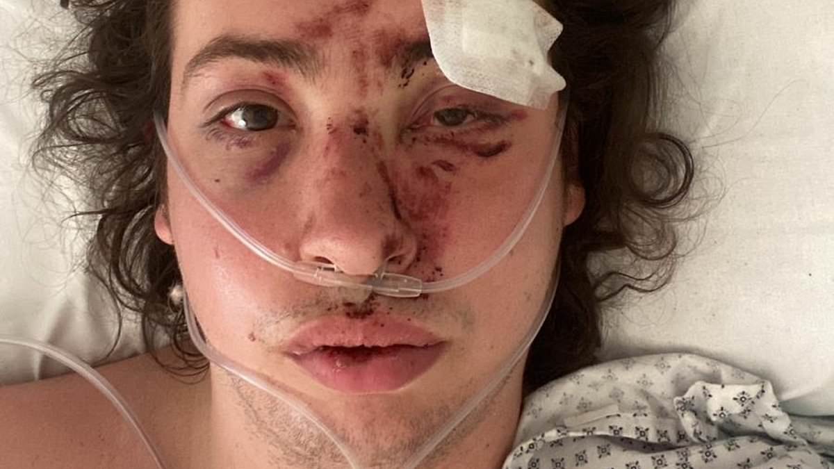 alert-–-brit-cheats-death-after-breaking-nearly-every-bone-in-his-face-in-horror-skiing-accident-in-italy:-22-year-old-reveals-he’s-only-starting-to-‘recognise-himself’-after-undergoing-major-12-hour-reconstructive-surgery