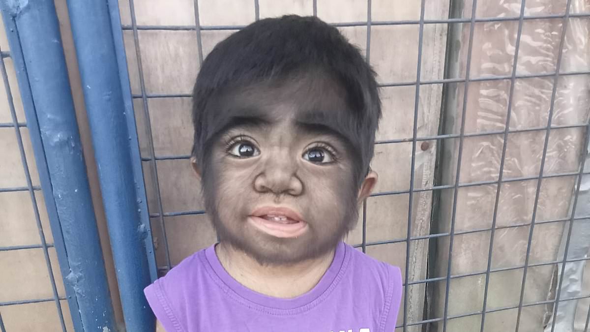 alert-–-mother-feared-her-son’s-‘werewolf-syndrome’-condition-was-caused-by-eating-a-cat-to-satisfy-her-cravings-while-she-was-pregnant