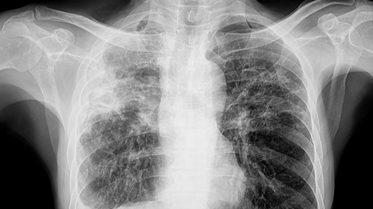 alert-–-tuberculosis-outbreak:-at-least-one-dead,-nine-hospitalized,-as-health-officials-declare-public-health-emergency-california