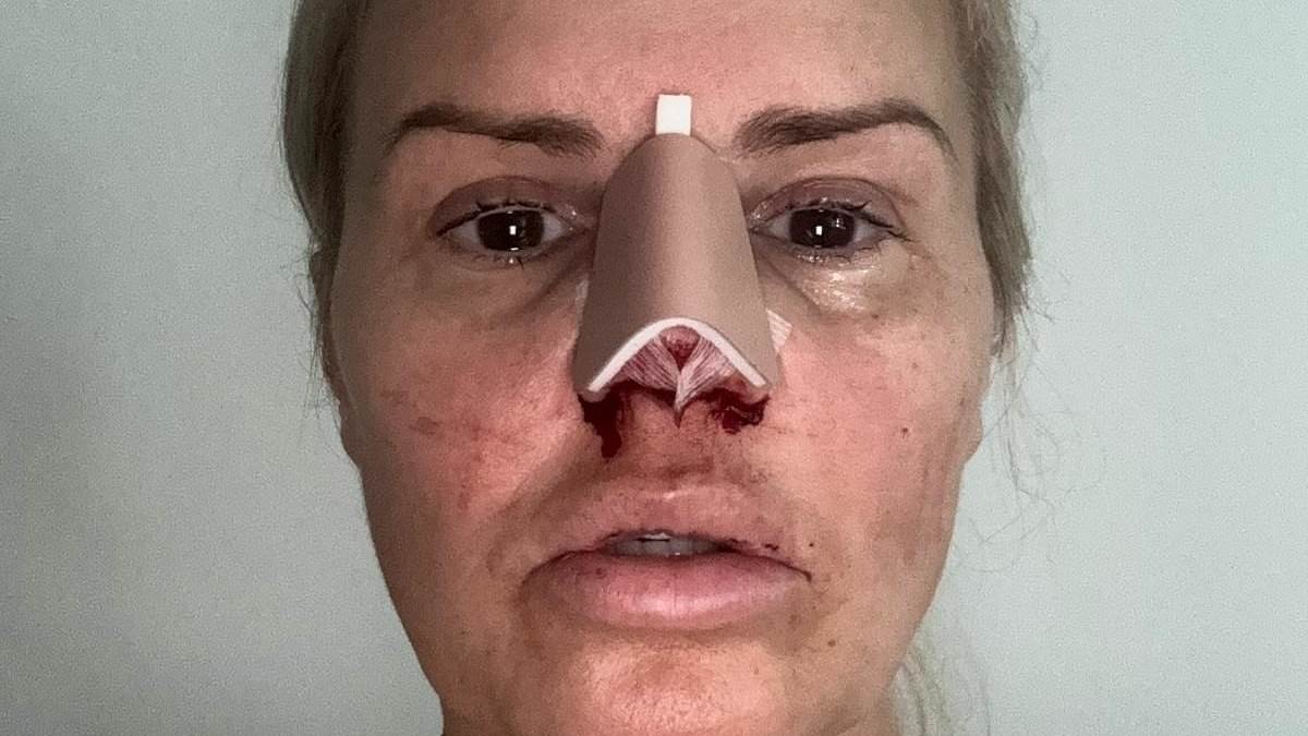 alert-–-kerry-katona-reveals-the-gruesome-results-of-her-nose-job-after-going-under-the-knife-due-to-past-cocaine-abuse-leaving-her-with-a-hole-in-her-septum