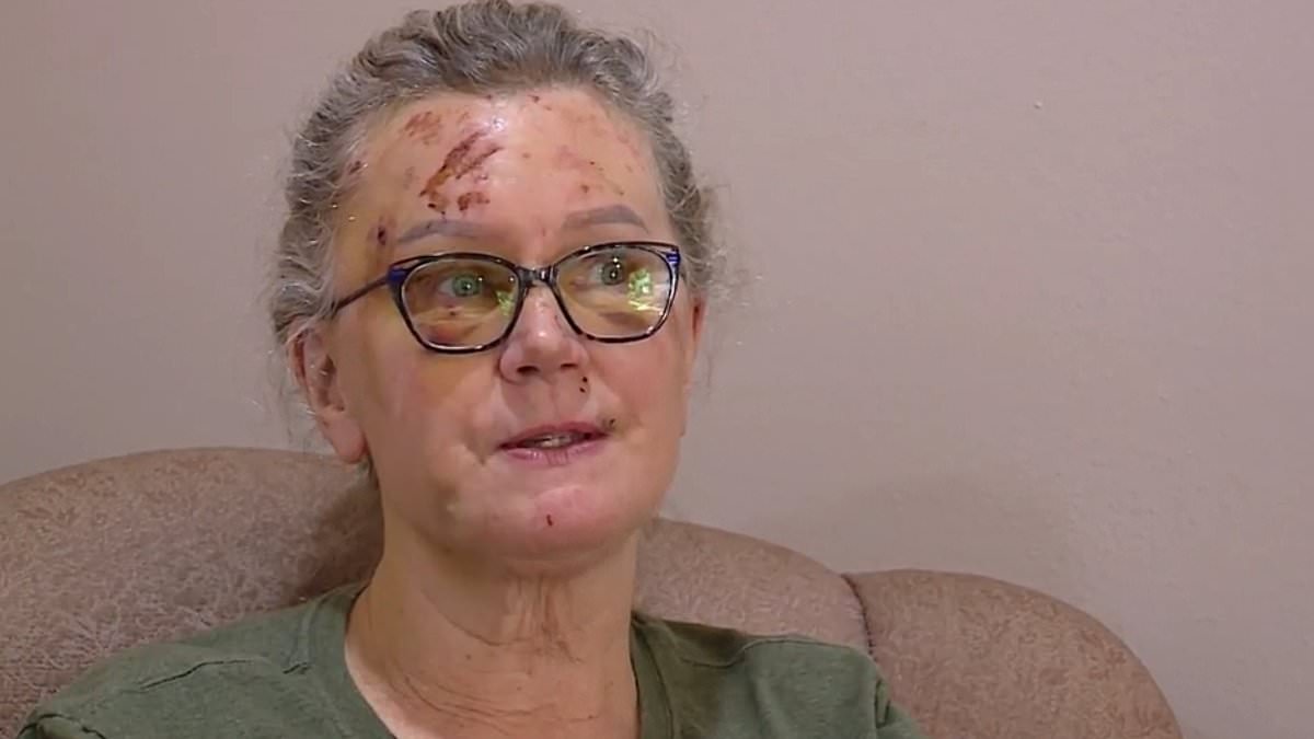 alert-–-female-hiker,-63,-shares-terrible-cuts-and-bruising-after-falling-300-feet-off-washington-mountain-during-trip-to-admire-wildflowers