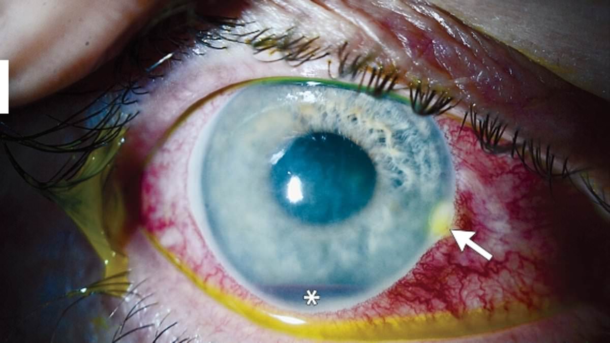 alert-–-doctors-remove-bee-stinger-from-philadelphia-man’s-eyeball-after-bleed-nearly-blinds-him