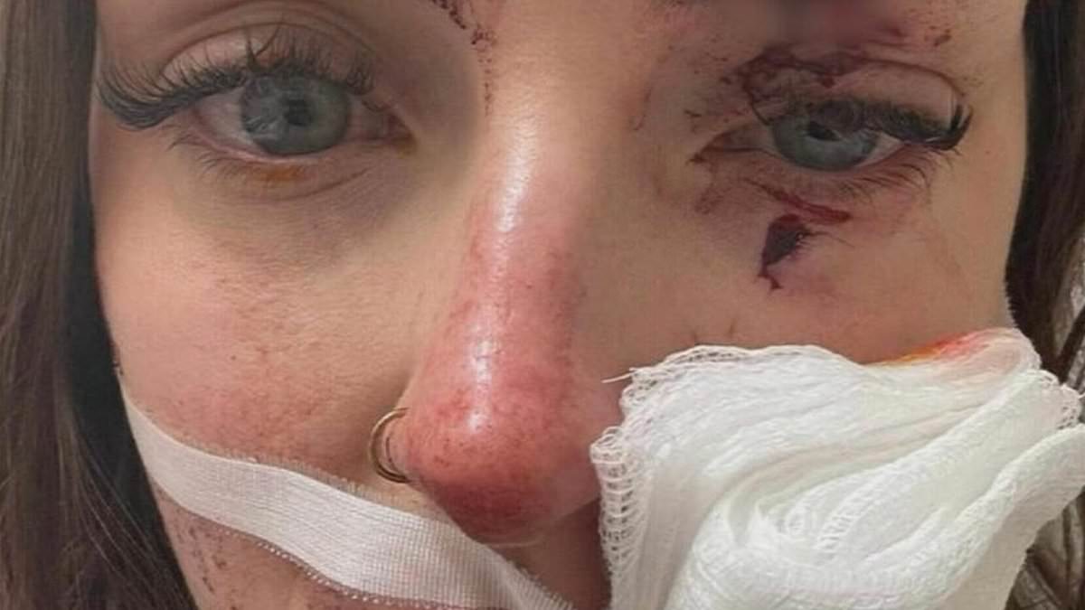 alert-–-horrific-facial-injuries-woman-suffered-after-being-allegedly-glassed-at-a-perth-pub