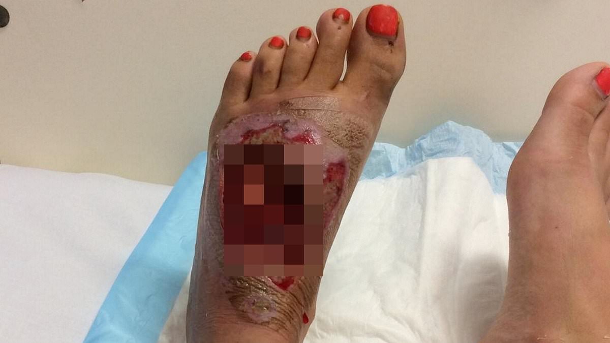 alert-–-i-nearly-lost-my-foot-after-it-was-impaled-by-metal-moped-stand-in-bali-horror-crash:-brit-tourist,-28,-warns-tourists-not-to-wear-flipflops-on-motorbikes-after-pothole-smash-left-her-with-gruesome-infection