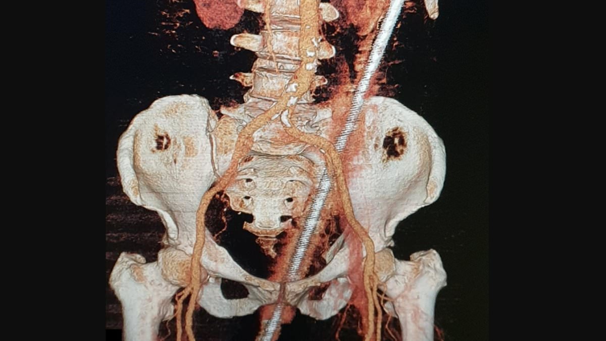 alert-–-doctors-remove-2ft-rusty-metal-rod-from-woman’s-backside-after-it-impaled-her-when-she-slipped-and-fell-in-her-backyard