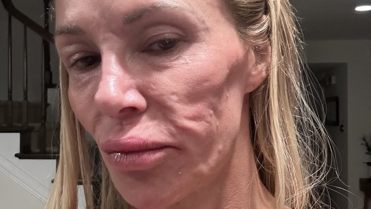 alert-–-botched-surgeon-issues-urgent-warning-to-brandi-glanville-and-shares-new-theory-about-her-‘parasite’-face