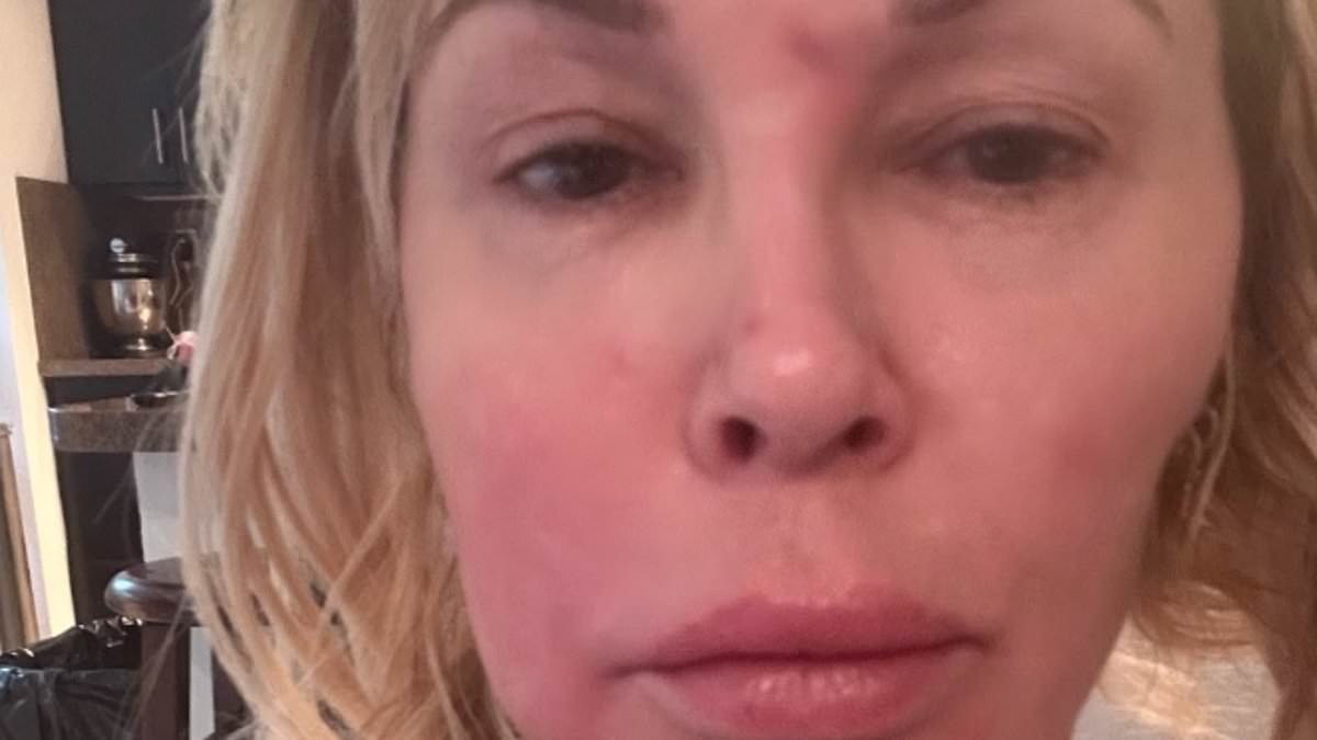 alert-–-brandi-glanville,-52,-shares-new-picture-of-her-swollen-face-as-she-reaches-out-to-botched-star-dr.-terry-dubrow-for-help-and-urges-people-to-‘be-kind’-after-claiming-disfigurement-was-caused-by-‘a-parasite’-and-‘stress’