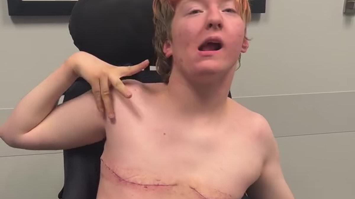 alert-–-truth-behind-disabled-trans-teen’s-shock-video-showing-breast-removal-scars:-‘i-wanted-to-blow-up-the-internet’