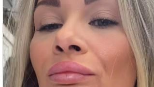 alert-–-shaughna-phillips,-30,-shows-off-dramatic-transformation-after-having-her-lip-filler-dissolved-as-she’s-left-‘shocked’-by-the-result