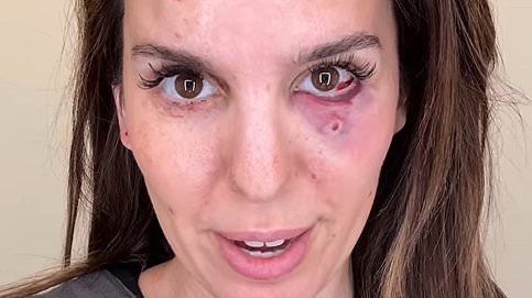 alert-–-christy-carlson-romano-reveals-she-was-‘shot-in-the-face’-at-husband’s-birthday-party:-‘grateful-to-be-alive’