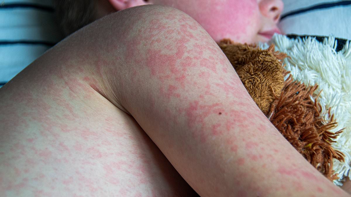 alert-–-measles-outbreak-reaches-worrying-milestone-as-doctors-reveal-what-99.2%-of-infected-people-have-in-common