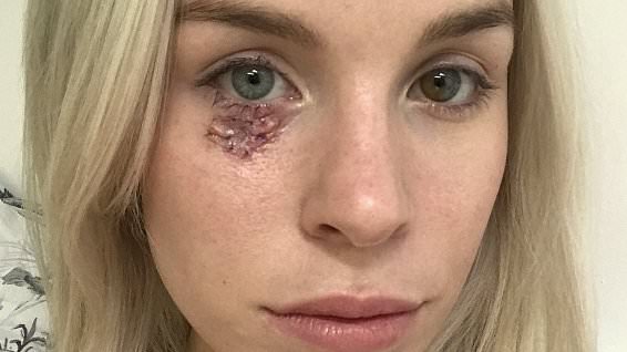 alert-–-i-thought-the-spot-under-my-eye-was-a-blocked-pore,-then-a-doctor-told-me-it-was-cancer.-the-cause-happened-in-my-childhood-and-i-had-no-idea…