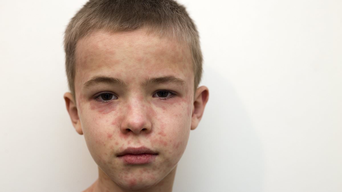 alert-–-multi-state-outbreak-fears-as-measles-hits-popular-tourist-attraction-with-untold-number-infected