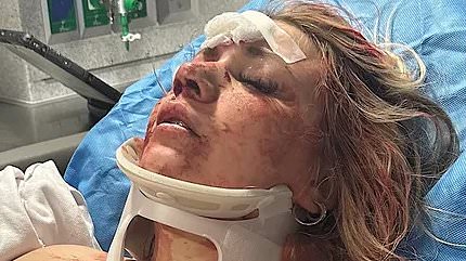 alert-–-astonishing-wedding-day-transformation-of-bride-who-was-beaten-bloody-in-brutal-bachelorette-party-attack
