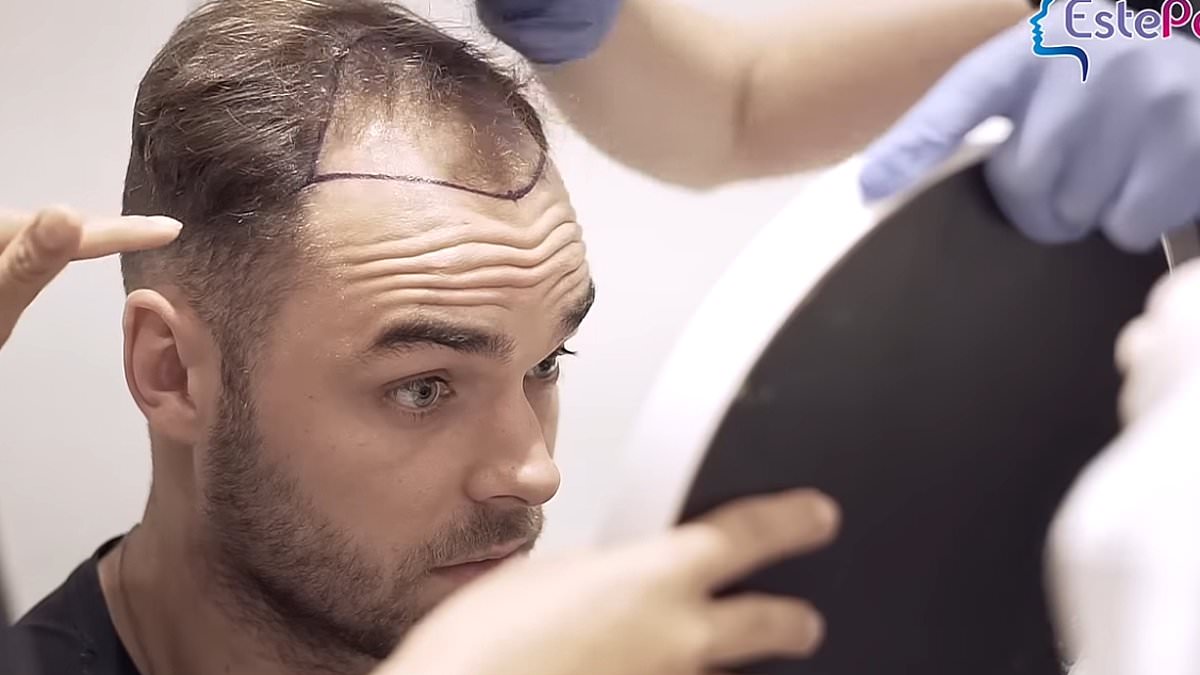 alert-–-love-island’s-harry-cooksley,-30,-and-ben-holbrough,-23,-look-unrecognisable-in-pre-villa-hair-transplant-footage