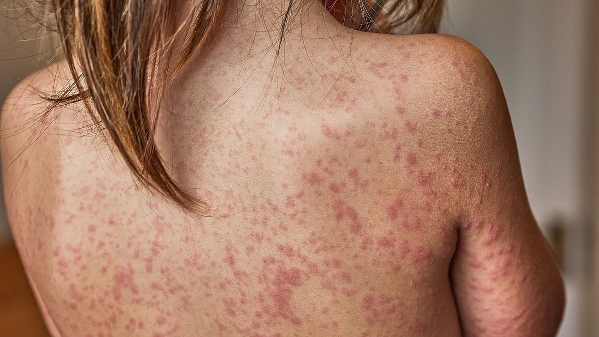 alert-–-urgent-health-warning-issued-for-sydney-after-person-with-measles-returns-from-vietnam