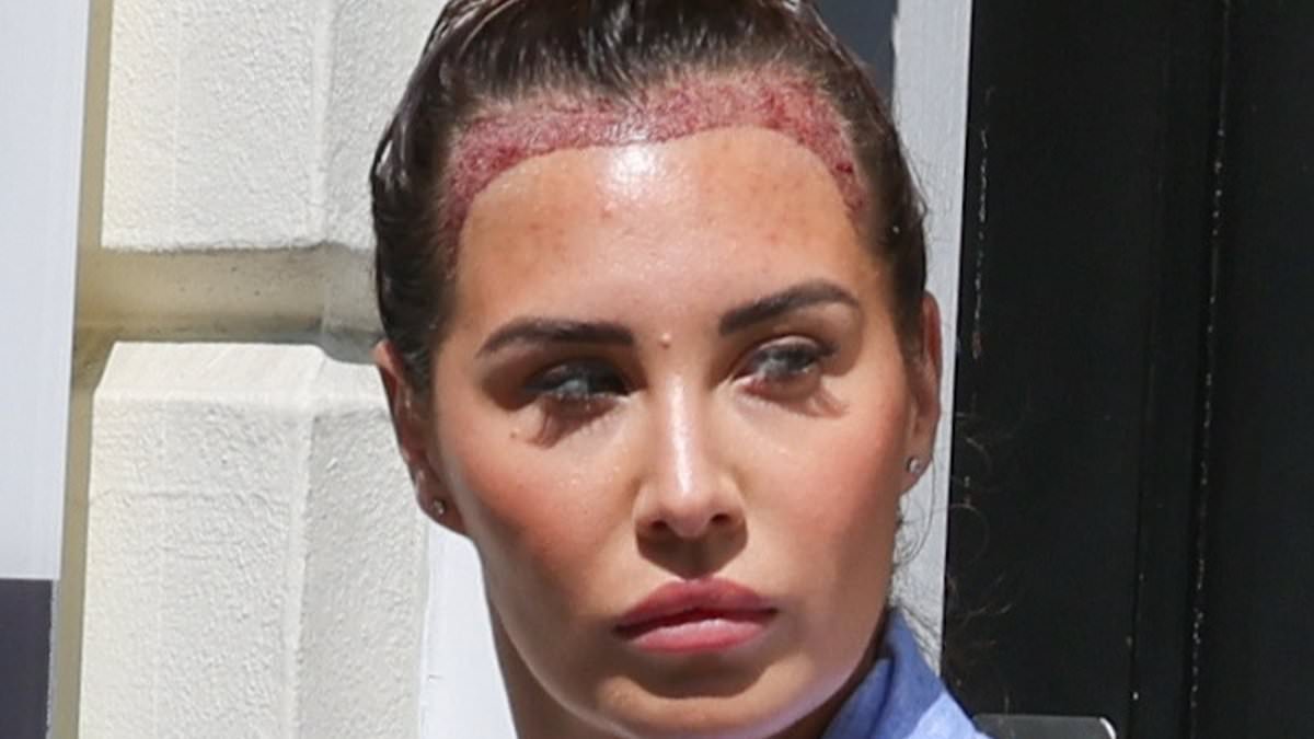 alert-–-chloe-goodman-shows-shocking-results-of-hair-transplant-as-star-is-seen-leaving-the-clinic-post-procedure