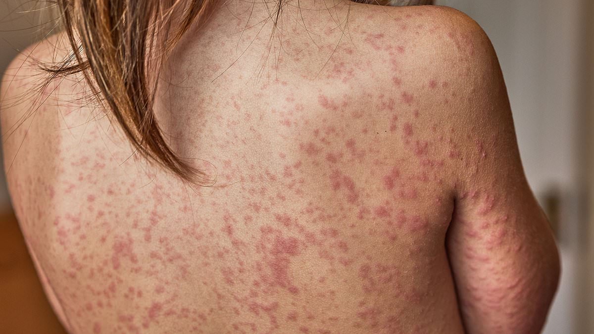 alert-–-child-dies-of-measles-in-liverpool-fueling-warnings-virus-could-spread-like-‘wildfire’-amid-plunging-vaccine-rates