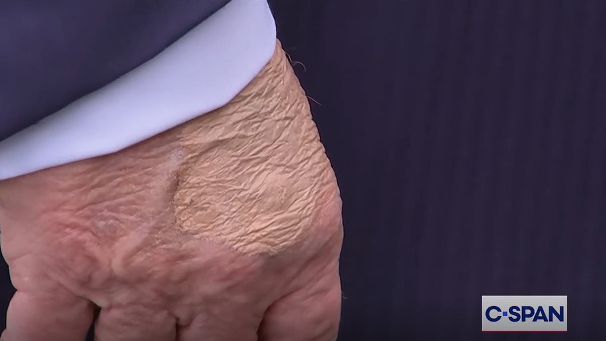 alert-–-fears-for-donald-trump’s-health-after-eagle-eyed-americans-spot-mysterious-markings-across-his-body…-as-experts-reveal-what’s-wrong-with-him