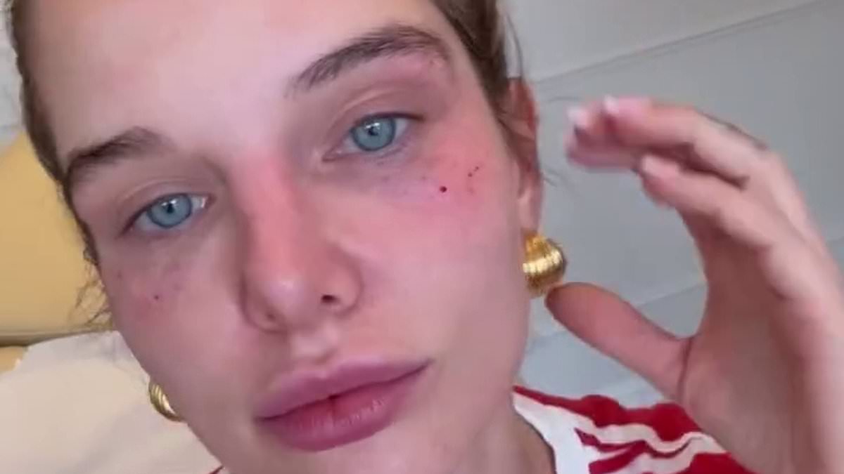 alert-–-helen-flanagan,-34,-sports-painful-looking-black-eye-after-undergoing-400-cosmetic-injections