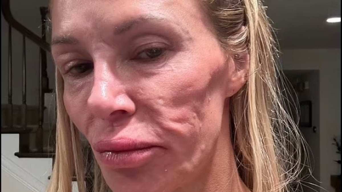 alert-–-real-housewives-star-claims-she-was-infected-by-same-parasite-that-disfigured-brandi-glanville