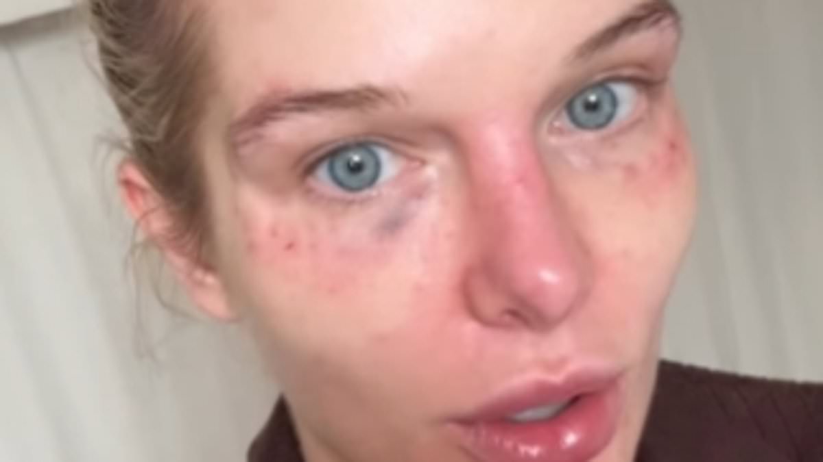 alert-–-helen-flanagan-goes-makeup-free-as-she-shows-off-painful-bruising-on-her-face-to-fans-after-revealing-she’s-had-500-cosmetic-procedure